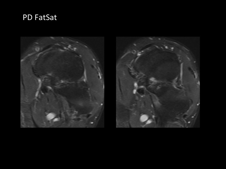 Figure 3 for case navicular-cuboid coalition